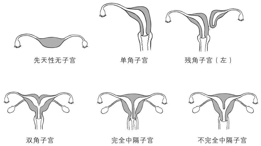 子宫发育异常图示 ?《女生呵护指南》