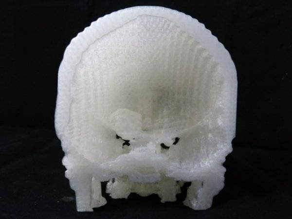 技术宅用3D打印帮助妻子治疗脑瘤02.jpg