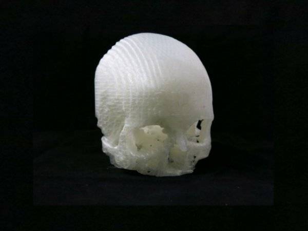 技术宅用3D打印帮助妻子治疗脑瘤03.jpg