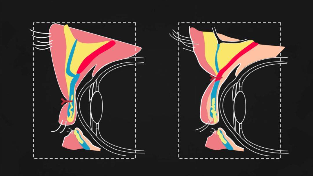 因此,重睑术只要人为地把皮肤与深层的睑板或者提睑肌及其腱膜相粘连