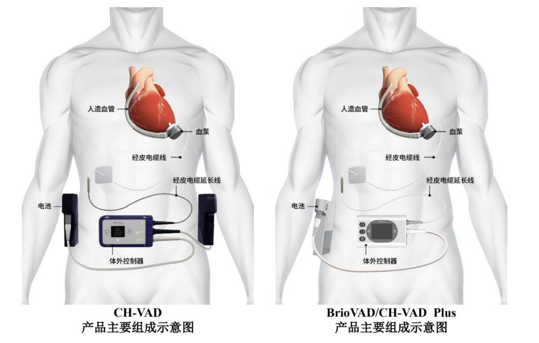 In-Depth Analysis of Technological Competitive Advantages Between Tongxin Medical's CH-VAD and Abbott's HeartMate 3 Artificial Hearts